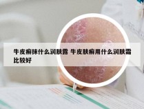 牛皮癣抹什么润肤露 牛皮肤癣用什么润肤霜比较好