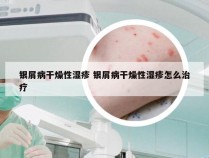 银屑病干燥性湿疹 银屑病干燥性湿疹怎么治疗