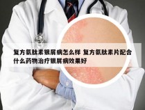 复方氨肽素银屑病怎么样 复方氨肽素片配合什么药物治疗银屑病效果好