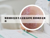 银屑病长在鼻子上还能治好吗 银屑病鼻毛变白