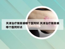 天津治疗银屑病哪个医院好 天津治疗银屑病哪个医院好点