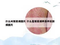 什么叫银屑病图片 什么是银屑病啊各种皮肤病图片