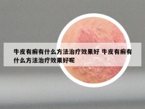 牛皮有癣有什么方法治疗效果好 牛皮有癣有什么方法治疗效果好呢