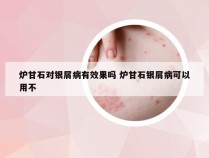 炉甘石对银屑病有效果吗 炉甘石银屑病可以用不