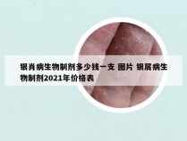 银肖病生物制剂多少钱一支 图片 银屑病生物制剂2021年价格表