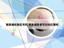 银屑病吃地瓜号码 银屑病患者可以吃红薯吗