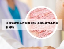 冷敷凝胶对头皮癣有用吗 冷敷凝胶对头皮癣有用吗