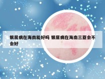 银屑病在海南能好吗 银屑病在海南三亚会不会好