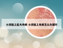 小孩腿上起大块癣 小孩腿上有癣怎么办图片