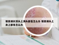 银屑病长到头上满头都是怎么办 银屑病头上身上都有怎么办