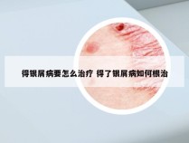 得银屑病要怎么治疗 得了银屑病如何根治