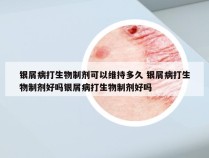 银屑病打生物制剂可以维持多久 银屑病打生物制剂好吗银屑病打生物制剂好吗