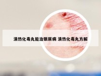 清热化毒丸能治银屑病 清热化毒丸方解