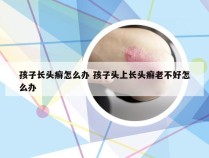 孩子长头癣怎么办 孩子头上长头癣老不好怎么办