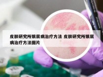 皮肤研究所银屑病治疗方法 皮肤研究所银屑病治疗方法图片