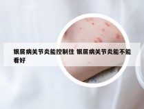 银屑病关节炎能控制住 银屑病关节炎能不能看好