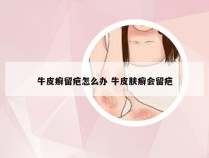 牛皮癣留疤怎么办 牛皮肤癣会留疤