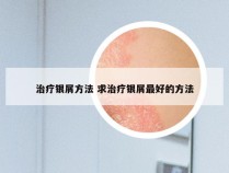 治疗银屑方法 求治疗银屑最好的方法