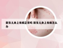 新生儿身上有癣正常吗 新生儿身上有癣怎么办