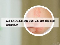 为什么外伤会引起牛皮癣 外伤感染引起的银屑病怎么治