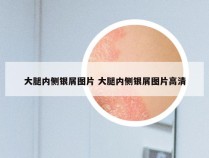 大腿内侧银屑图片 大腿内侧银屑图片高清