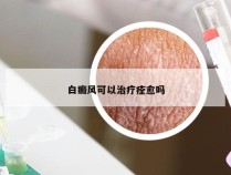 白癜风可以治疗痊愈吗