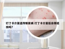 打了卡介苗遗传银屑病 打了卡介苗后会得结核吗?