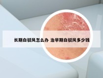 长期白驳风怎么办 治早期白驳风多少钱