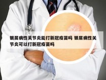 银屑病性关节炎能打新冠疫苗吗 银屑病性关节炎可以打新冠疫苗吗