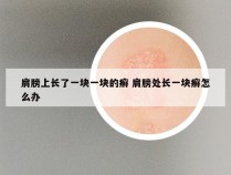 肩膀上长了一块一块的癣 肩膀处长一块癣怎么办