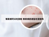 银屑病可以吃蛋糕 银屑病患者能吃蛋糕吗