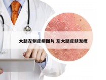 大腿左侧皮癣图片 左大腿皮肤发痒