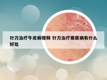 针刀治疗牛皮癣视频 针刀治疗银屑病有什么好处