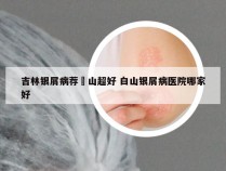 吉林银屑病荐崋山超好 白山银屑病医院哪家好