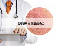 疡毒银屑病 银屑病溃烂