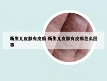 新生儿皮肤有皮癣 新生儿皮肤有皮癣怎么回事