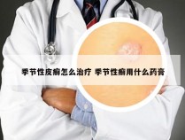 季节性皮癣怎么治疗 季节性癣用什么药膏