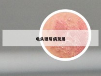 龟头银屑病发展