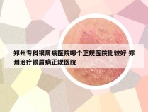 郑州专科银屑病医院哪个正规医院比较好 郑州治疗银屑病正规医院