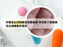 孕期怎么控制脓包性银屑病 孕妇得了银屑病可以用哪些外用药