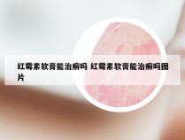 红霉素软膏能治癣吗 红霉素软膏能治癣吗图片