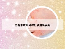 患有牛皮癣可以打新冠疫苗吗