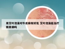 用艾叶泡澡对牛皮癣有好处 艾叶泡澡能治疗银屑病吗