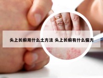 头上长癣用什么土方法 头上长癣有什么偏方