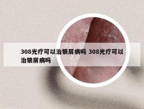 308光疗可以治银屑病吗 308光疗可以治银屑病吗