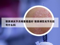 银屑病关节炎哪里看最好 银屑病性关节炎挂号什么科