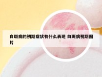 白斑病的初期症状有什么表现 白斑病初期图片