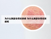 为什么胸部会得皮肤癣 为什么胸部会得皮肤癣呢