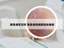 银屑病常见吗 银屑病得病原因有哪些