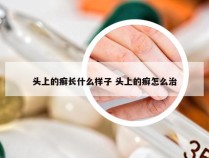 头上的癣长什么样子 头上的癣怎么治